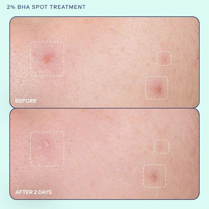 SKINFIX Acne+ 2% BHA and Azelaic Acid Acne Spot Treatment