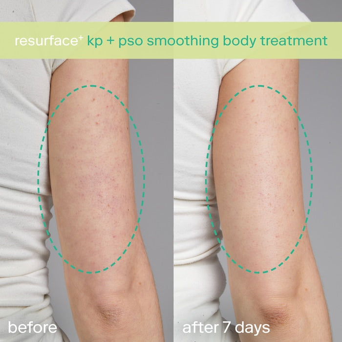 SKINFIX Resurface+ AHA Renewing Body Cream