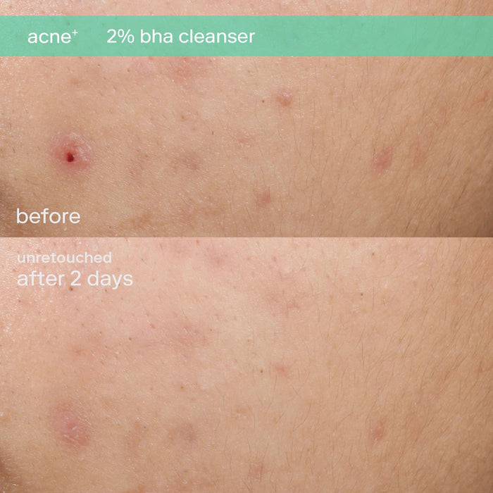 SKINFIX Mini Acne+ 2% BHA + Azelaic Acid + Niacinamide + AHA Cleanser