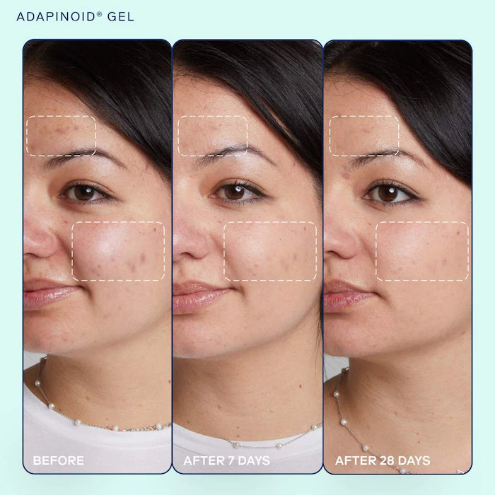 SKINFIX acne+ adapinoid Gel with Niacinamide + Squalane