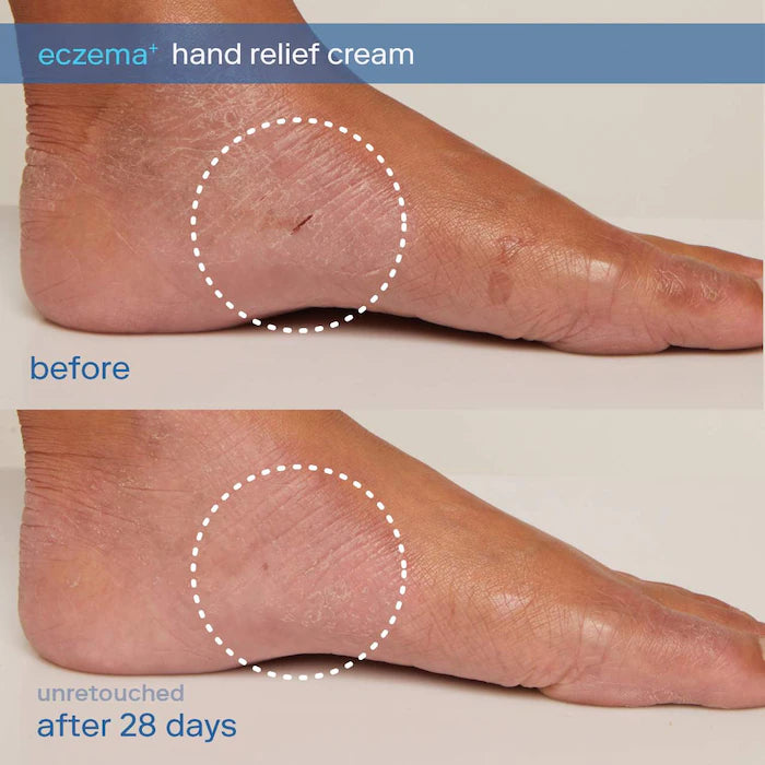 SKINFIX Eczema+ Ceramide Hand + Foot Relief Cream