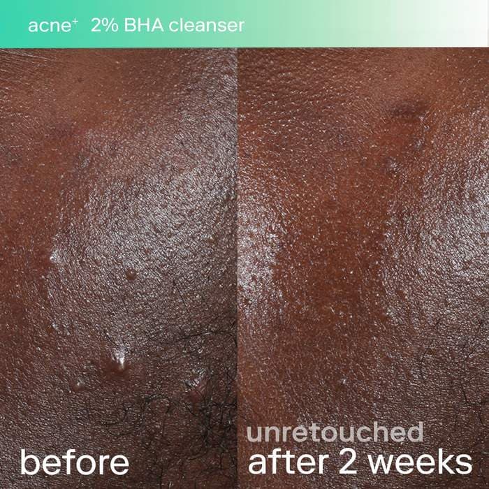 SKINFIX acne+ triple threat set with Salicylic Acid (BHA) + Niacinamide with B-L3™